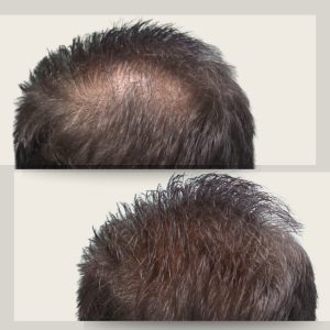 Before & After Toppik Hair Building Fibers Dark Brown 12gr