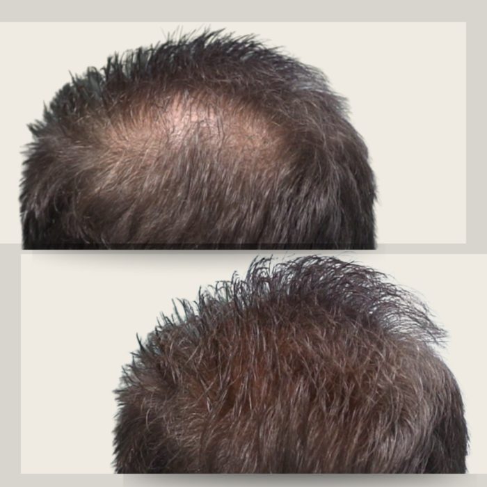 Before & After Toppik Hair Building Fibers Dark Brown 12gr