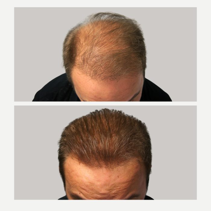 Before & After Toppik Hair Building Fibers Medium Brown 55gr