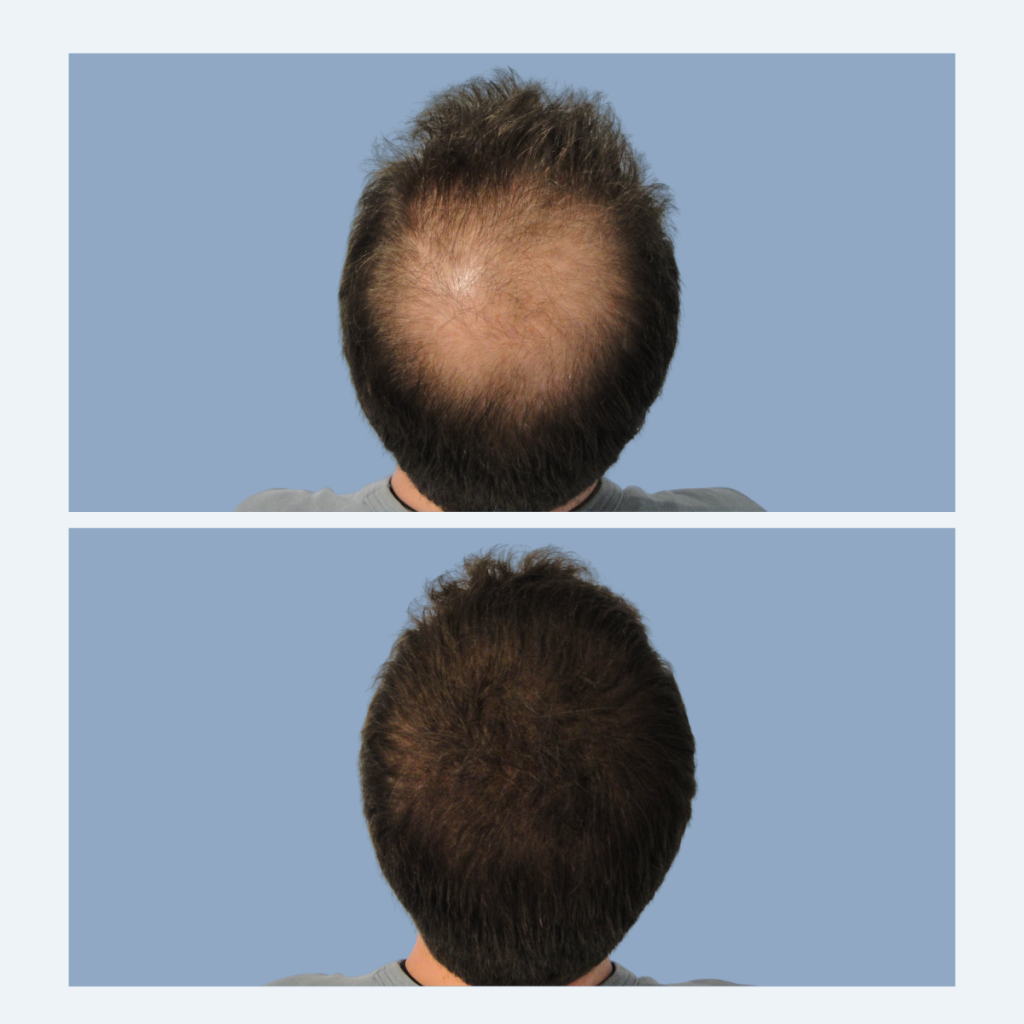 εφαρμογή ινών πύκνωσης στην κορυφή