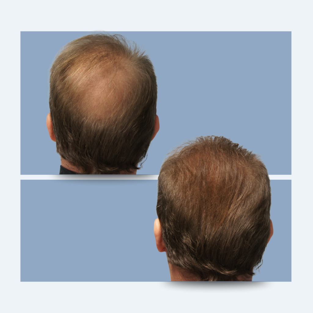 Πώς φαίνεται η αραίωση στην κορυφή των μαλλιών