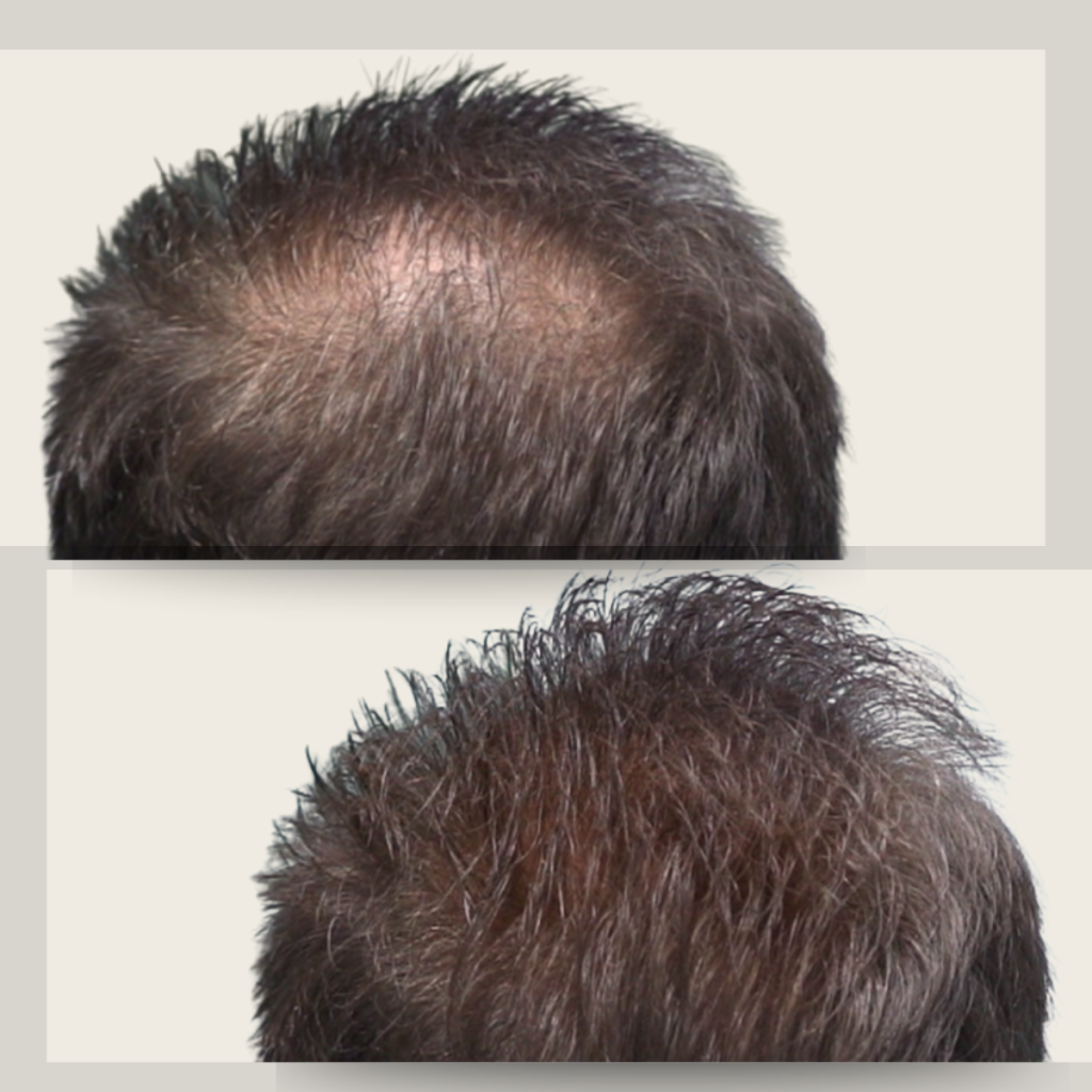 Πότε οι ίνες πύκνωσης είναι η πιο αποτελεσματική λύση για το crown